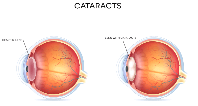 cataract-surgery-treatment-for-cataracts